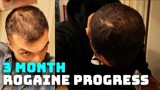 3 Month Rogaine Results and Progress Minoxidil [upl. by Lanni]