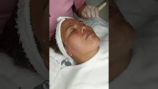 LIFTING INMEDIATO PLASMA PEN DR PEN Y CUPPING FACIAL [upl. by Yllil978]