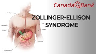 ZollingerEllison syndrome [upl. by Norah]