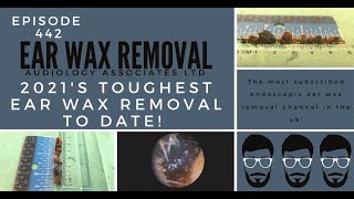 2021s TOUGHEST EAR WAX REMOVAL TO DATE  EP442 [upl. by Yelahc366]