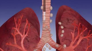 EBUS Procedure OverviewOlympus Bronchoscopy [upl. by Fulvia]