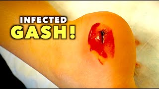 INFECTED GASH ON HER HEELWe Had to Deep Clean  Dr Paul [upl. by Elfie]