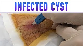 Infected Back Cyst  Drained and Packed [upl. by Zoellick]