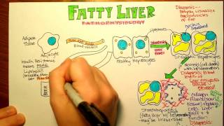 Fatty Liver Pathophysiology [upl. by Brothers460]