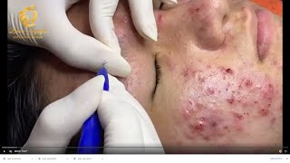 Treatment of acne tablets pustules and blackheads 359  Loan Nguyen [upl. by Elga]