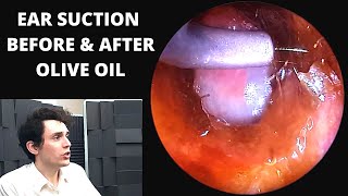 Ear Wax Suction BEFORE and AFTER Olive Oil 3 day gap [upl. by Aisset]