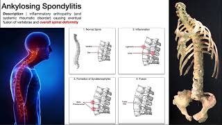 Ankylosing Spondylitis  Mechanism Risk Factors amp SignsSymptoms [upl. by Garlan819]