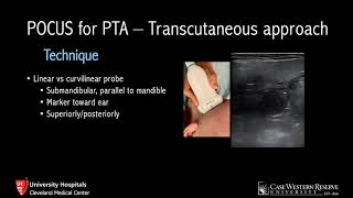 Adenoidectomy  actual footage [upl. by Sephira]