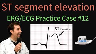 ST Elevation  EKG  ECG Interpretation Case 12 STEMI MI ACS [upl. by Ahsirak633]