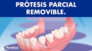 Prótesis parcial removible  ¿Cómo funcionan © [upl. by Lehteb765]