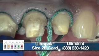 Replacing Crowns on Teeth 710 With BruxZir® Anterior [upl. by Thurmann]