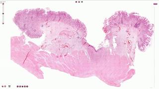 Peptic Ulcer  Histopathology [upl. by Theodora56]