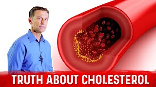 The Truth About Cholesterol – LDL Cholesterol amp HDL Cholesterol – DrBerg [upl. by Mintz124]