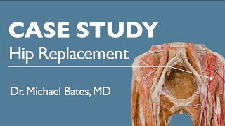 Hip Replacement Surgery Explained [upl. by Nyleve994]