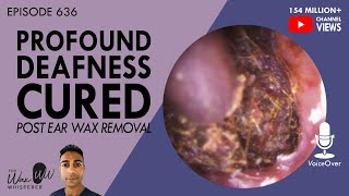 636  Profound Deafness Cured Post Ear Wax Removal [upl. by Bryan]