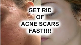 HOW TO GET RID OF ACNE SCARS  Pershii [upl. by Eerb40]