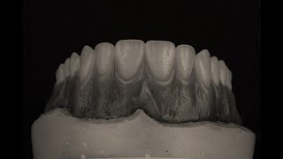 Escultura Gingival y Festoneado en Prostodoncia Total Superior [upl. by Shank]