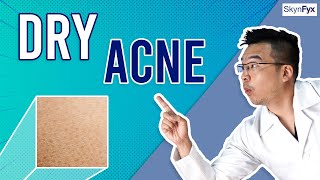 How To Treat Dry Skin  Acne Dry Acne  5 Tips To Follow [upl. by Tiffanie920]