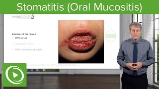 Managing Oral Mucositis Mouth Sores Before Treatment Begins [upl. by Yblehs]