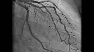 Coronary Angiography  NEJM [upl. by Doownel]