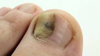 Tolnaftate for Toenail Fungus [upl. by Malet]