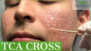 Acne Scar Removal with TCA Cross 80  Los Angeles  Dr Ben Behnam [upl. by Korwin]