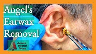 Angels Earwax Removal  Auburn Medical Group [upl. by Nythsa708]