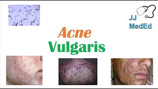 Acne Vulgaris  Causes Pathogenesis Influencing Factors Diagnosis Treatment and Complications [upl. by Ahsiki]