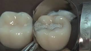 Class II Amalgam Preparation amp Restoration  Operative Dentistry [upl. by Taft367]