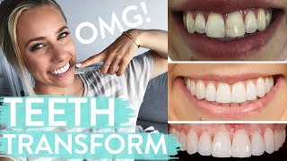 TEETH TRANSFORMATION  Porcelain Veneers  Before amp After  Review [upl. by Alyakcim]