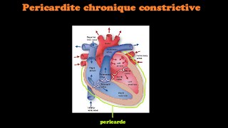 SmartNEasy Cardio  Pericardite Chronique Constrictive  Dr Astuce [upl. by Syned792]