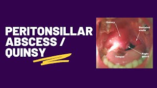 Tonsillar Squamous Cell Carcinoma [upl. by Peg435]