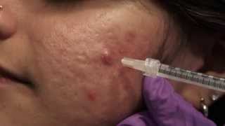 Watch amp Learn Intralesional injections [upl. by Ciapas]