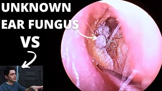 Ear Fungal Infection VS Audiologist [upl. by Bird]