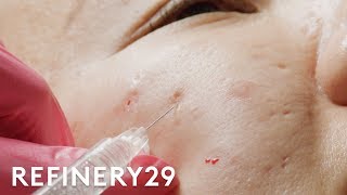 I Got Fillers For My Acne Scars  Macro Beauty  Refinery29 [upl. by Singh]