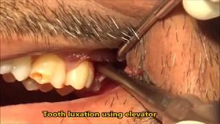 Endodontic treatment of the single rooted tooth Part 6 Obturation [upl. by Oidacra]