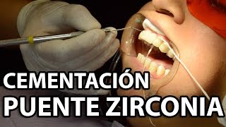 Cementación Puente Zirconia 6 Unidades👅Parte2 [upl. by Columbus474]