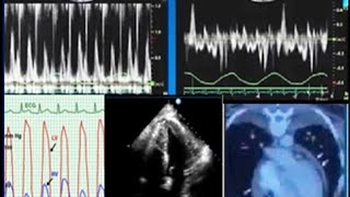 Constrictive pericarditis Etiology and presentation [upl. by Aivek]