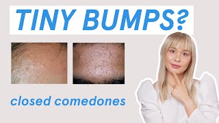 Why those tiny bumps AREN’T fungal acne [upl. by Pattie]