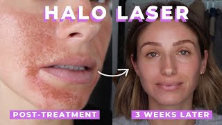 HALO LASER TREATMENT REVIEW  SKIN LASER [upl. by Edgar]