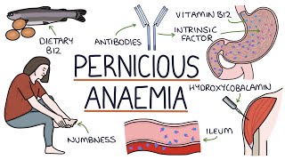 Understanding Pernicious Anaemia B12 Deficiency [upl. by Eltotsira]