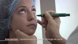 Chirurgie des cernes  Lipostructure du cerne [upl. by Denni]