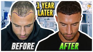 My Hair Transplant Results After 1 Year [upl. by Aneen673]