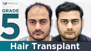 Hair Transplant Before amp After  6 Month Results  3500 Grafts transplanted in Front and Hairline [upl. by Andria]