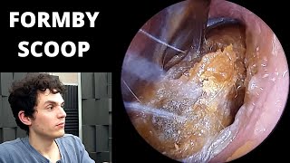 Formby Scoop Used To Extract Hard Wax From Small Ear [upl. by Akeinahs]