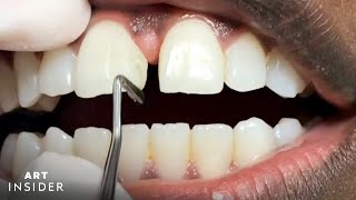 How Tooth Gaps Are Filled  Insider Art [upl. by Eelac106]