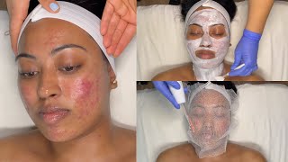 CYSTIC ACNE TREATMENT  WALKIN FACIAL FOR GRADE 3 AND 4 ACNE WITH PRO TIPS  LICENSED ESTHETICIAN [upl. by Leinod550]