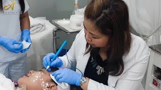 Warts removal Cautery [upl. by Ahsai]