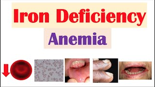 IronDeficiency Anemia Overview  Causes Pathophysiology Signs amp Symptoms Diagnosis Treatment [upl. by Etnud]