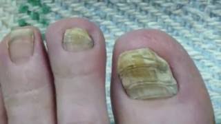 Toe Nail Fungus Cure 30 Months Progress [upl. by Artemus57]